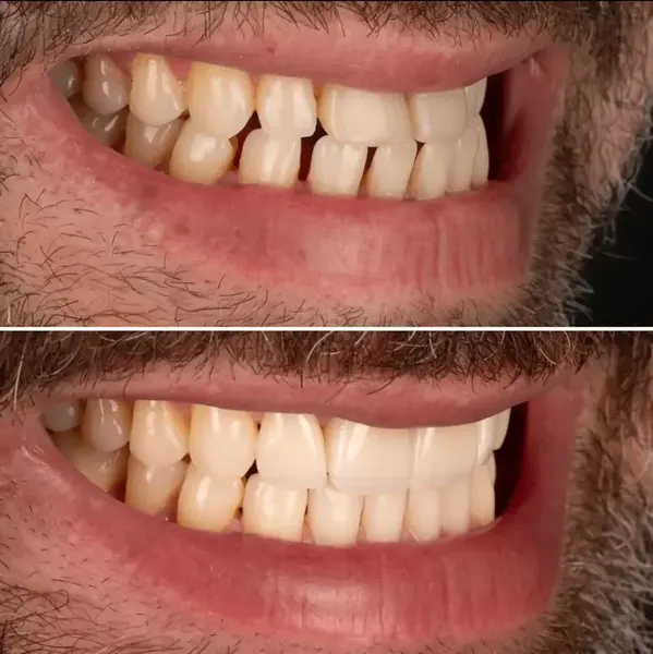 Antes e depois — Caso 4 de transformação de sorriso na Clínica Racy