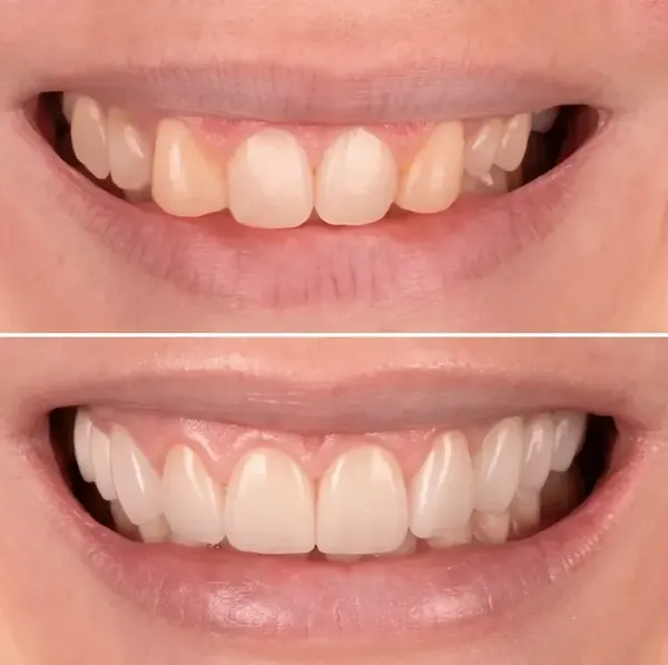 Antes e depois — Caso 1 de transformação de sorriso na Clínica Racy