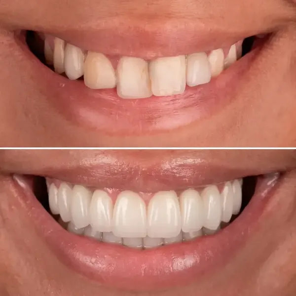 Antes e depois — Caso 3 de transformação de sorriso na Clínica Racy