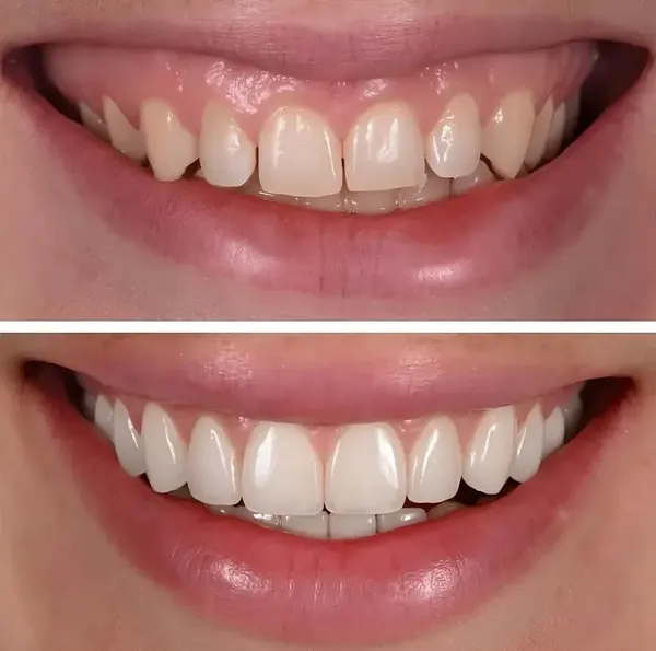 Antes e depois — Caso 5 de transformação de sorriso na Clínica Racy