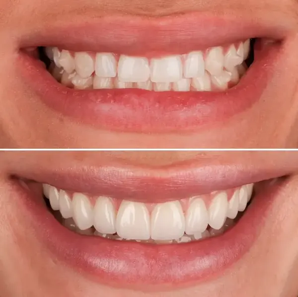 Antes e depois — Caso 2 de transformação de sorriso na Clínica Racy